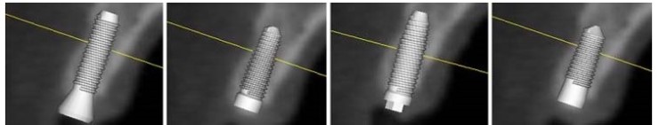 안정적인 임플란트 시술을 위해 모의수술이 필요한 이유 관련 이미지 5