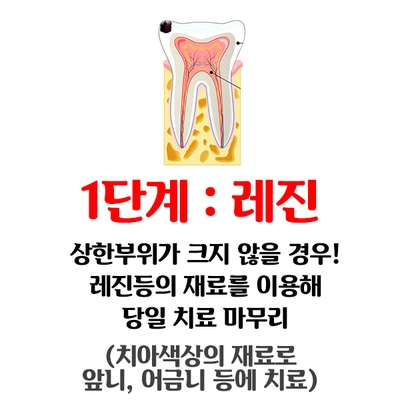 [충치치료종류] 충치치료 언제까지 참으실건가요?? 관련 이미지 5