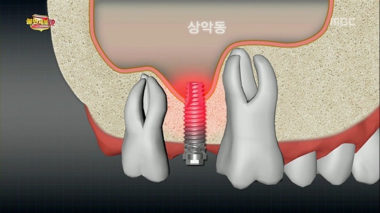 불만제로UP 28화 임플란트 부작용 나 몰라라! 임플란트 가격은 부르는 데로! 관련 이미지 4
