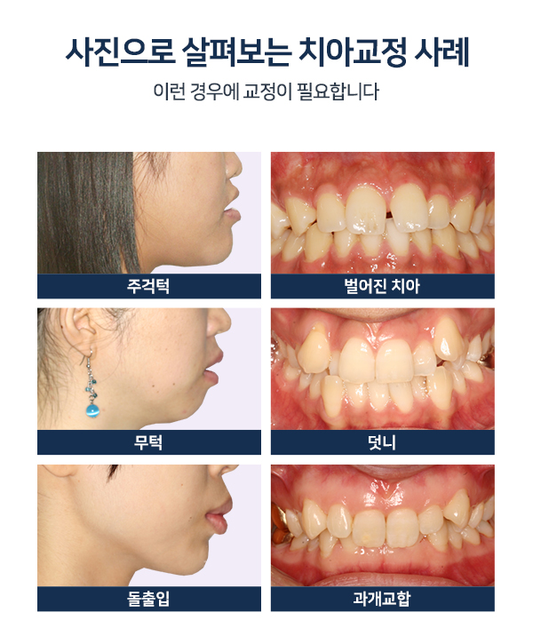 치아사이벌어짐, 라미네이트? 부분교정? 선택은! 관련 이미지 7