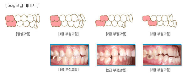치아교정 종류와 비용 알아보기 관련 이미지 10
