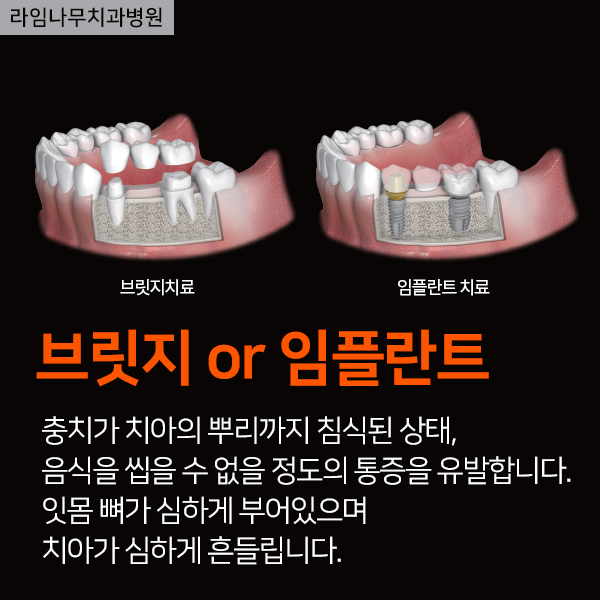 보철치료종류(레진,인레인,크라운) 유지관리방법 관련 이미지 5
