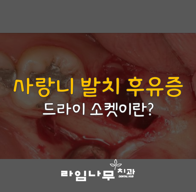 사랑니발치 후유증 드라이소켓! 명동치과 라임나무가 알려드려요 관련 이미지 1