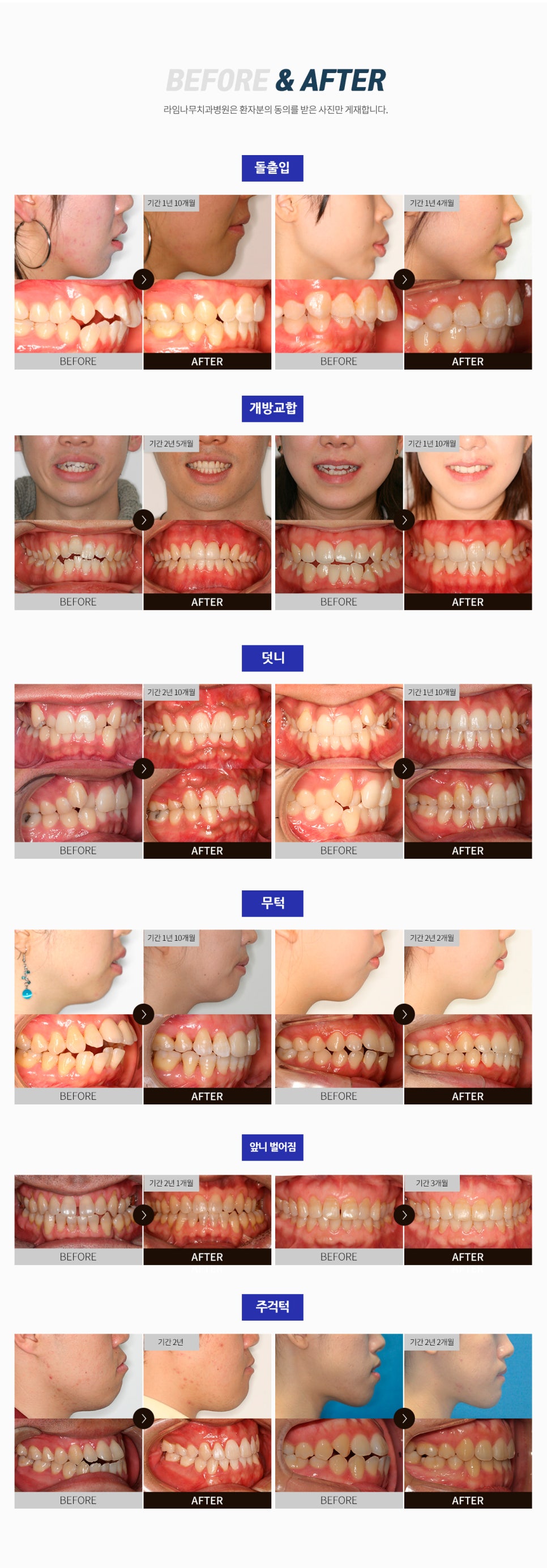 여름방학 맞이 치아교정 이벤트를 실시합니다! 관련 이미지 7