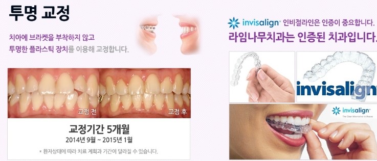 몰래 티 안나게 교정하고 싶은 마음, 시크릿 교정의 모든 것을 소개합니다 관련 이미지 8