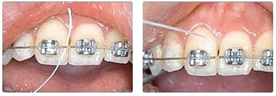 치아교정 중 양치질은 어떻게 하는 것이 좋을까 관련 이미지 6