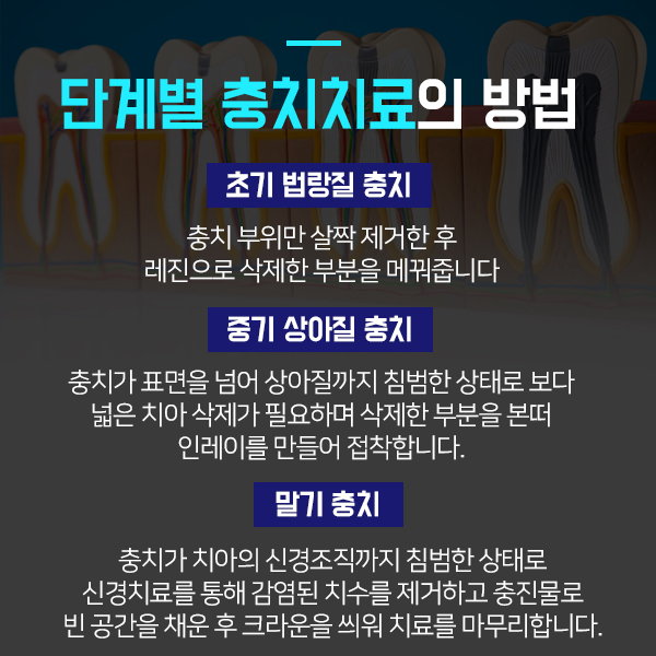 명동치과 충치예방과 치료방법에 대해 알아봐요 관련 이미지 3
