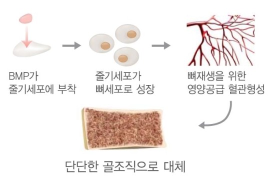 동종골? 합성골? 자가골? 뼈이식 임플란트의 종류를 알아보자! 관련 이미지 5