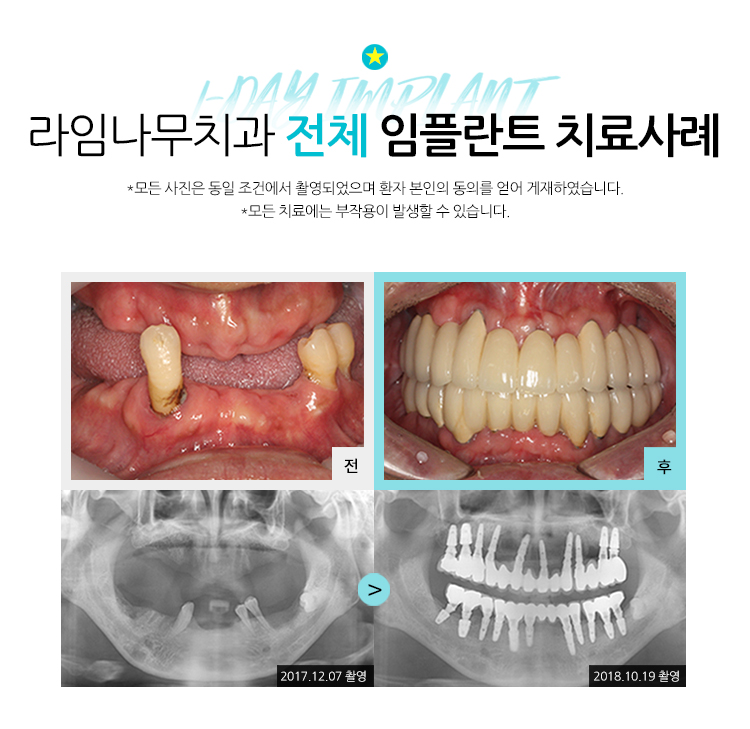 무치악임플란트 알아보고 계신다면? 라임나무치과에서 상담 받으세요! 관련 이미지 12