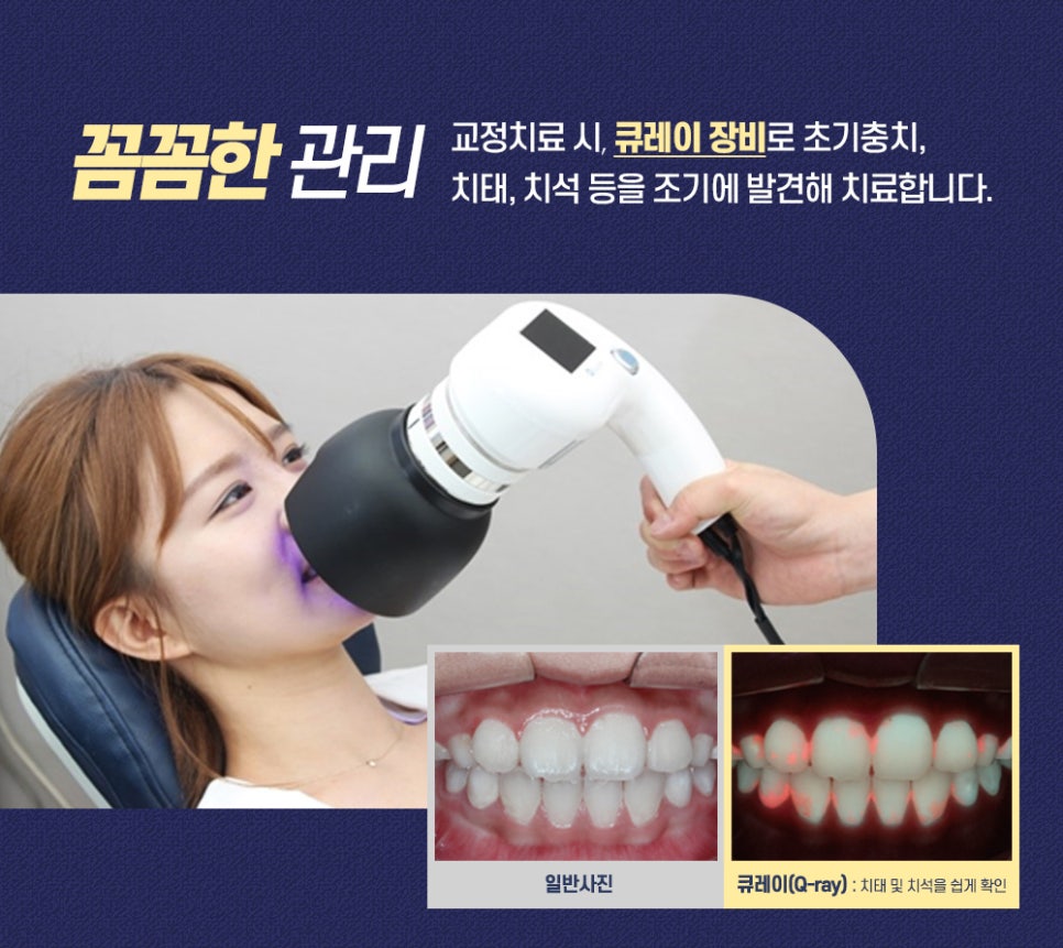 치과 수능이벤트, 라임나무치과병원 인비절라인으로 새 학기 준비 관련 이미지 4