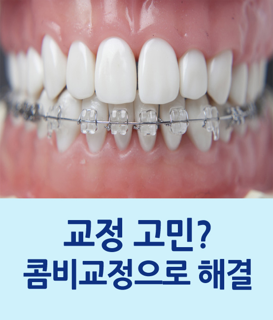 [명동치과]치아교정, 눈에 잘 띄지 않고 비용도 합리적인 콤비교정 인기 관련 이미지 1