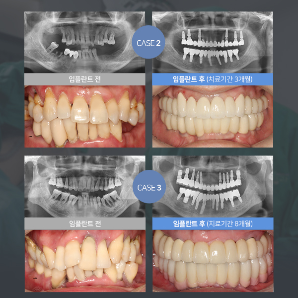 뼈이식임플란트 신중히 알아보자구요 관련 이미지 10