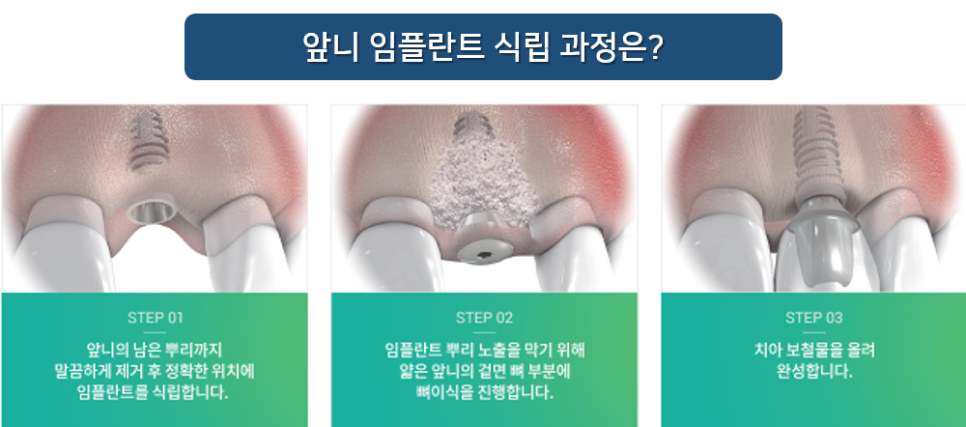 앞니 임플란트 후기 티나지 않아요 명동치과 라임나무 관련 이미지 3