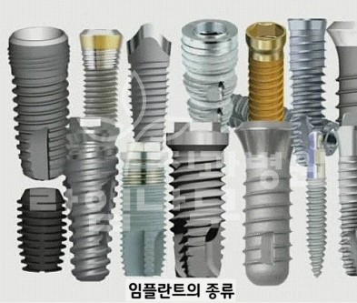 임플란트 이야기  VOL2 : 국산 임플란트와 외산임플란트의 차이 관련 이미지 2