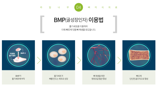 임플란트 기간 얼마나 걸릴까? 임플란트 뼈이식, 임플란트 종류 관련 이미지 5