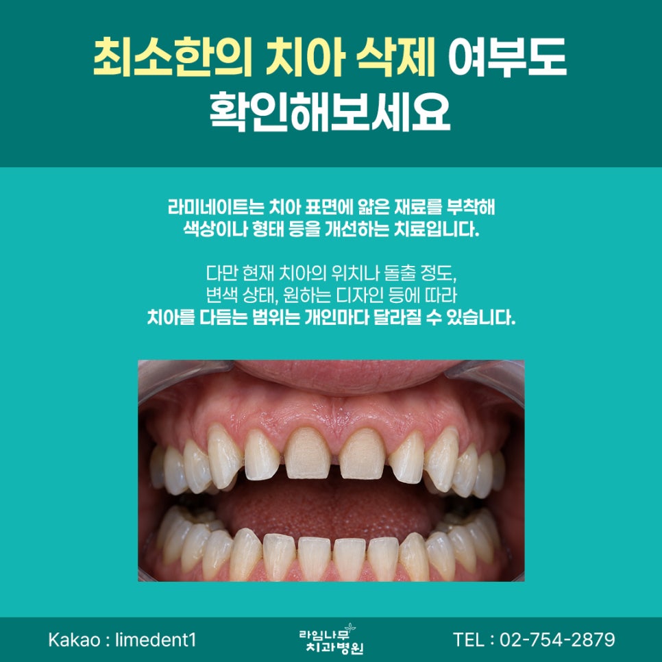 명동 라미네이트 전 꼭 확인해야 할 자연스러운 치아 디자인 기준 관련 이미지 7