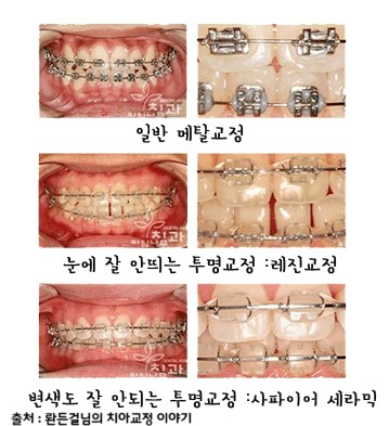 한 눈에 보는 치아교정 - 치아교정 장치의 종류 관련 이미지 3
