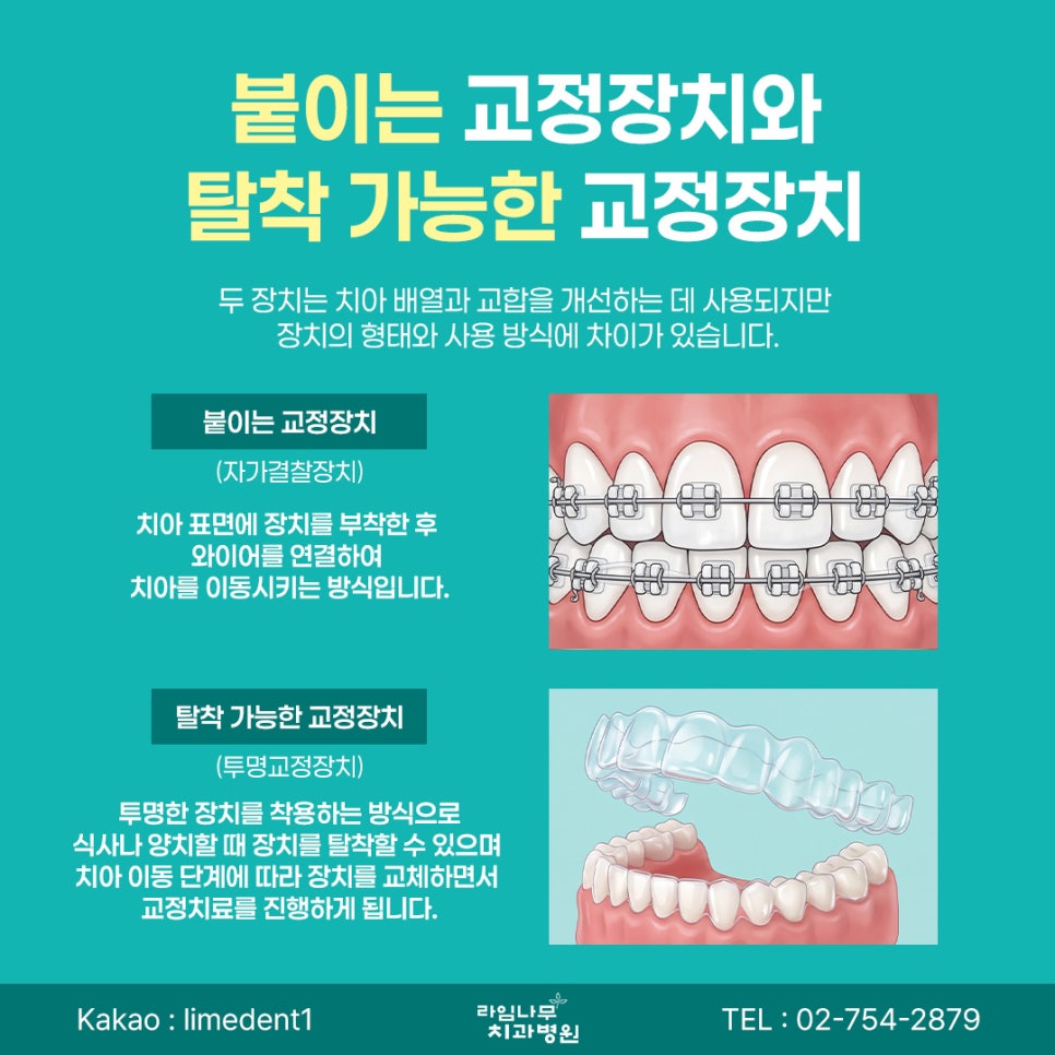 치아교정 시작 전, 알아둬야 할 체크포인트 관련 이미지 7