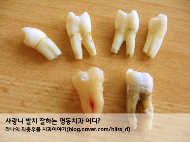 사랑니 발치 잘하는 명동치과 어디? 관련 이미지 1