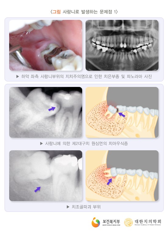 사랑니 발치에 대한 궁금증, 라나가 시원하게 해결해 드립니다 관련 이미지 5