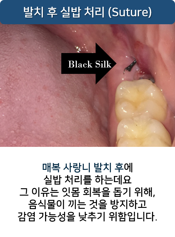 사랑니실밥 언제푸나요? 풀렸을때? 명동치과 라임나무 관련 이미지 2