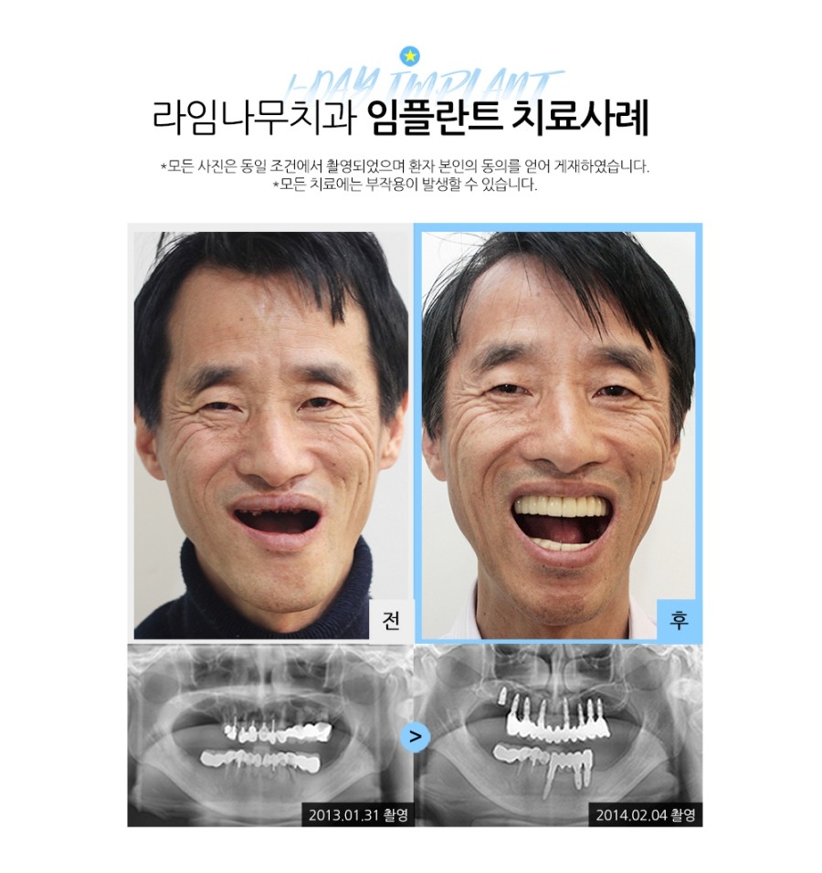 임플란트잘하는곳 라임나무치과병원입니다 관련 이미지 2