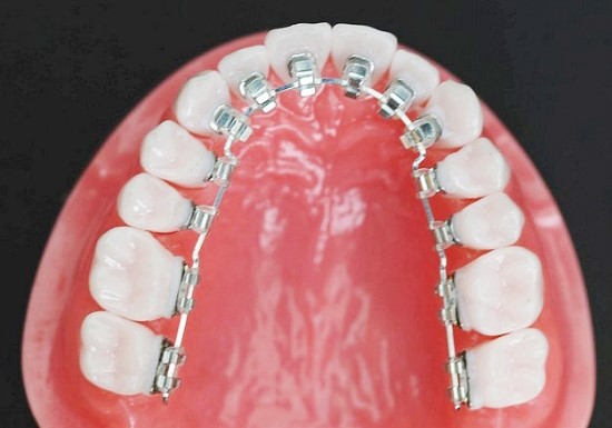 치아교정 종류와 비용 알아보기 관련 이미지 16