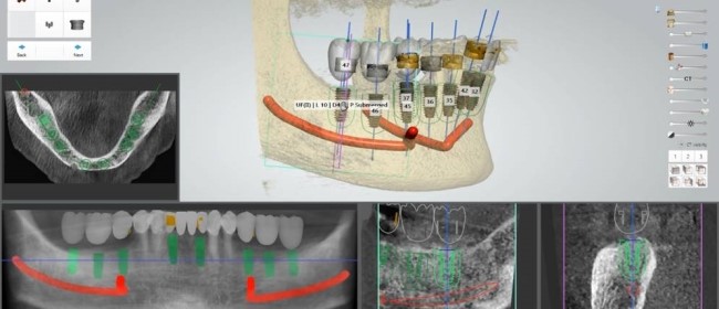 라임나무치과의 네비게이션 임플란트를 소개합니다 관련 이미지 4