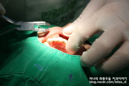 잠깐만요! 자가결찰교정장치 알고 가실께요~ 관련 이미지 2