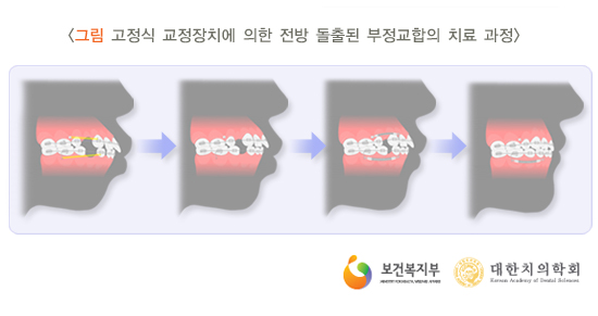 부정교합이란 무엇이며, 어떻게 치료할 수 있을까요 관련 이미지 6