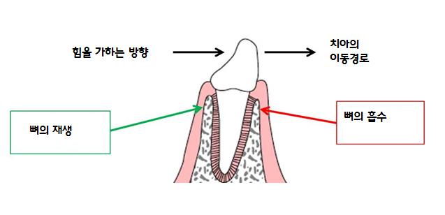 한 눈에 보는 치아교정 - 치아교정 원리 관련 이미지 5
