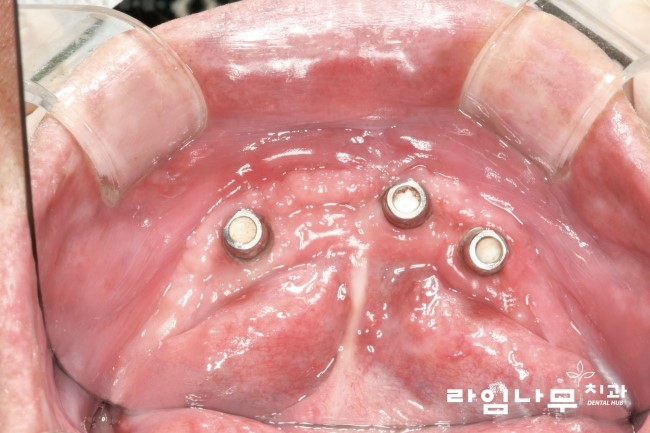 치아가 없다면? 치매 확율이 UP! 틀니임플란트로 해결보세요~ 관련 이미지 4
