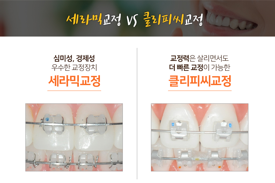 치아교정, 장치의 종류와 비용 알아보기 관련 이미지 2
