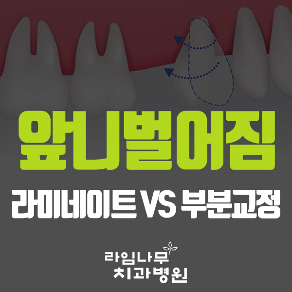 치아사이벌어짐, 라미네이트? 부분교정? 선택은! 관련 이미지 1