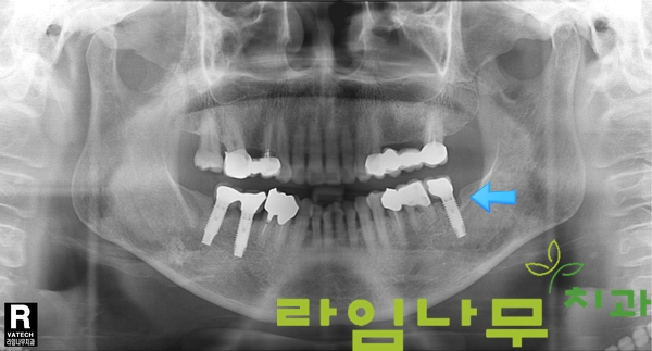 임플란트 재수술 증례! 믿을만한 곳 명동치과 라임나무치과 관련 이미지 3