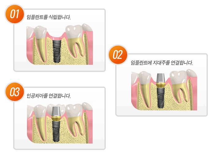 뼈이식 임플란트 시술과정 관련 이미지 1
