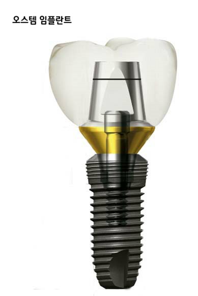 임플란트 이야기  VOL2 : 국산 임플란트와 외산임플란트의 차이 관련 이미지 4