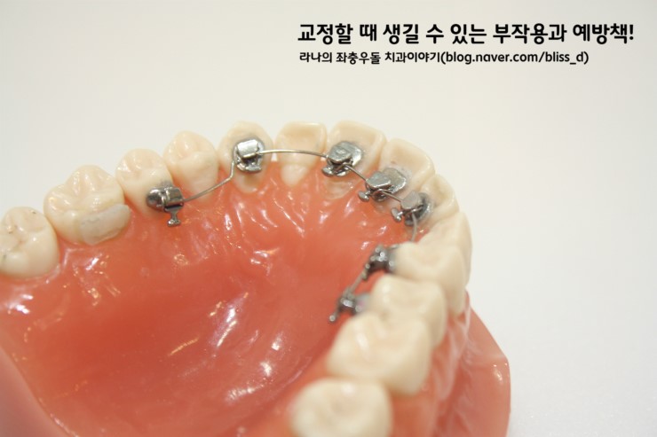 교정할 때 생길 수 있는 부작용과 예방책! 관련 이미지 1