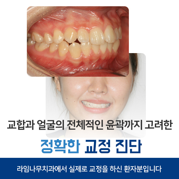 돌출입교정 과유불급! 너무들어가지않게 관련 이미지 4