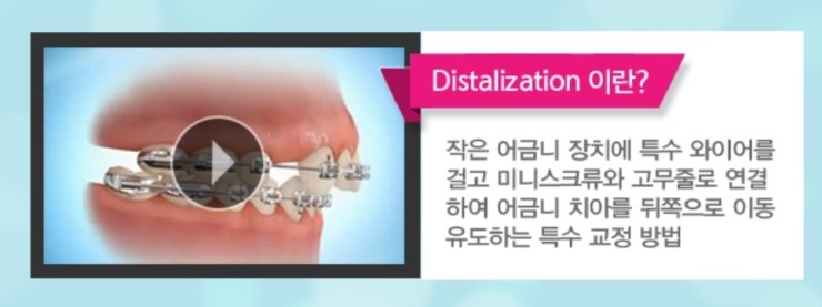 돌출앞니부분교정 토끼치아 탈출하자 관련 이미지 3