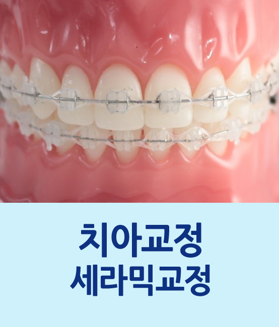 세라믹 교정 비용과 기간이 궁금하다면? 관련 이미지 1