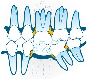 을지로치과가 알려드리는 임플란트 건강보험 적용 관련 정보 관련 이미지 4