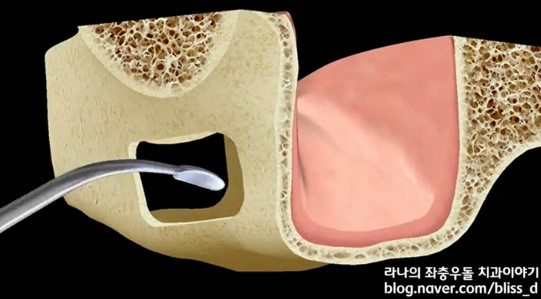 임플란트 뼈이식이 필요한 이유 관련 이미지 13
