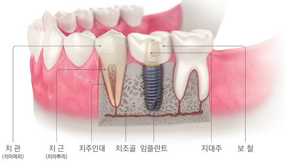 임플란트, 왜 필요할까요 관련 이미지 2