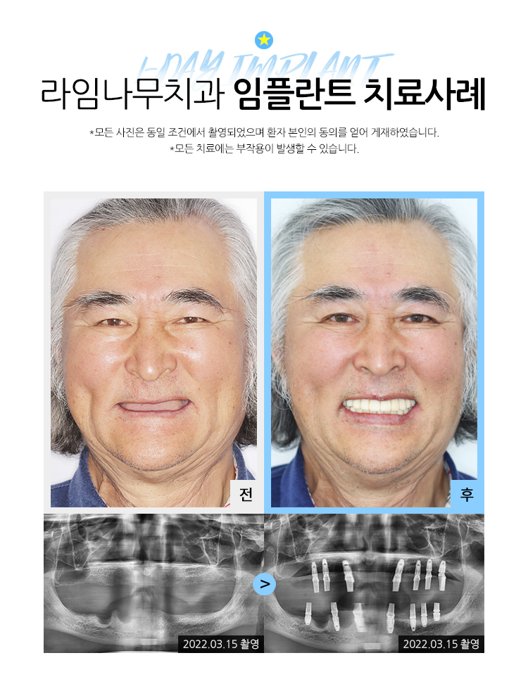 무치악임플란트 알아보고 계신다면? 라임나무치과에서 상담 받으세요! 관련 이미지 8