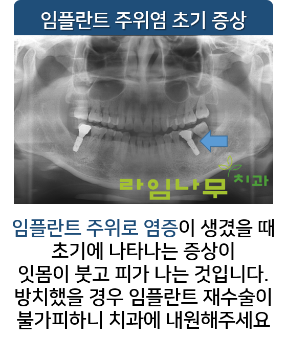 임플란트 부위 피날때, 문제점 알아봐요! 명동치과 라임나무 관련 이미지 3