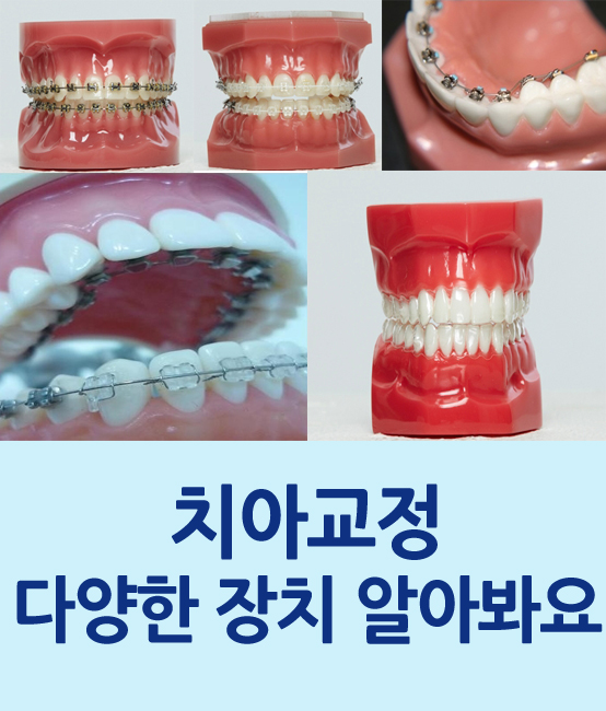 치아교정, 어떤 종류가 있을까요 관련 이미지 1
