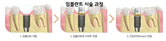 당뇨임플란트 치료방법 관련 이미지 9