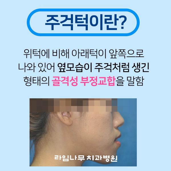 [명동치과] 주걱턱 수술 없이 교정 가능할까요? 라임나무치과 주걱턱 교정 알아보기! 관련 이미지 2