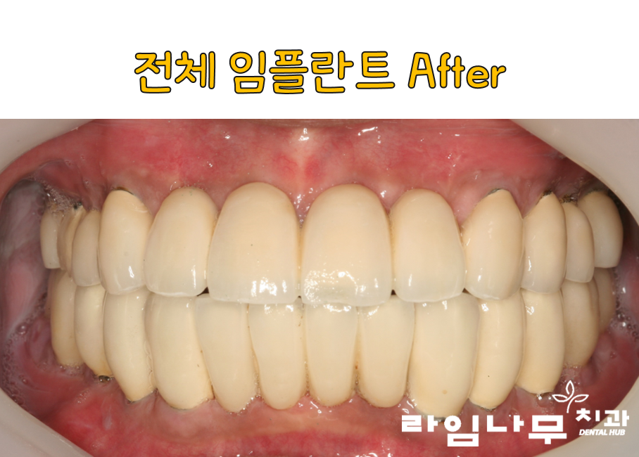 명동치과 전체임플란트 증례! 치주염으로 전체 치아의 기능을 상실한 치아 관련 이미지 5